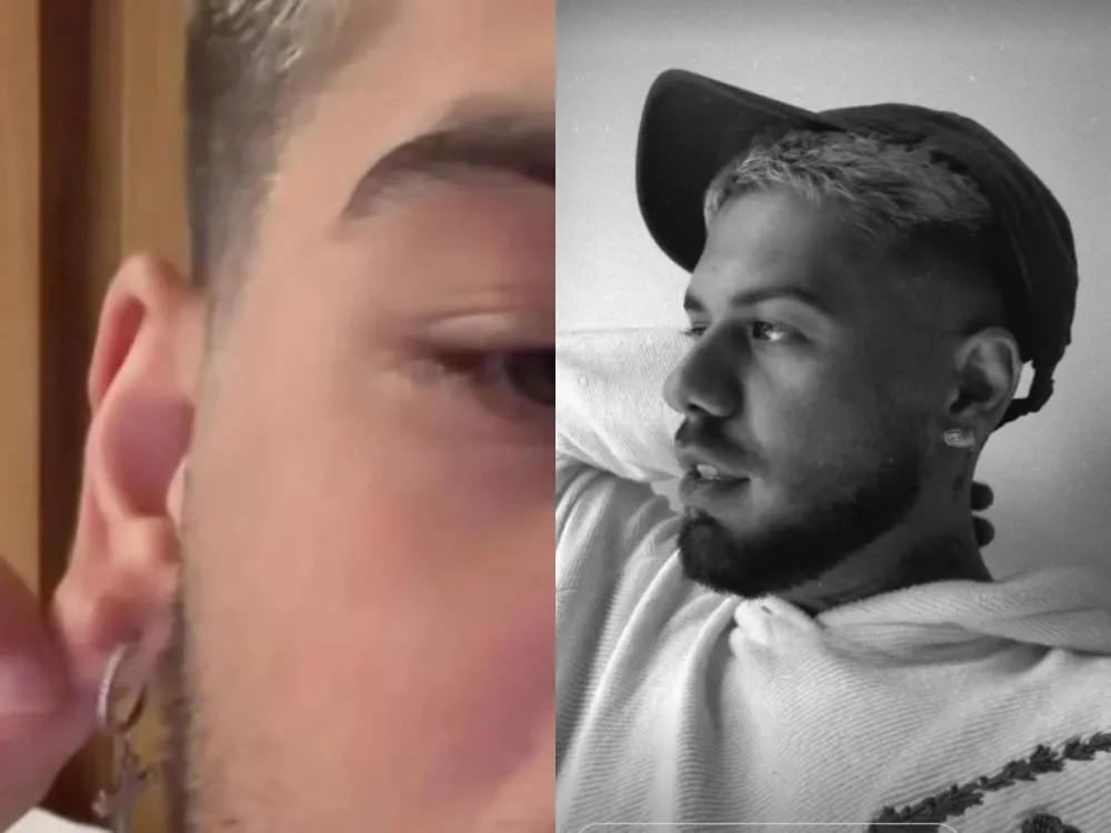 Zé Felipe passa por novo procedimento após acidente com a orelha: “Não cuidei e deu isso”