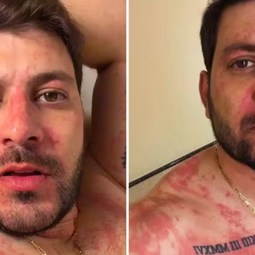 Caio Afiune relata susto após crise alérgica severa durante viagem
