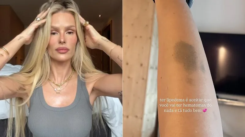 Yasmin Brunet desabafa ao mostrar hematoma causado pelo lipedema