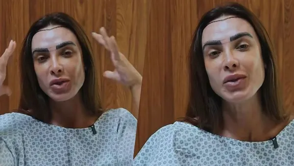 Nicole Bahls faz transplante capilar sem raspar os fios e explica decisão